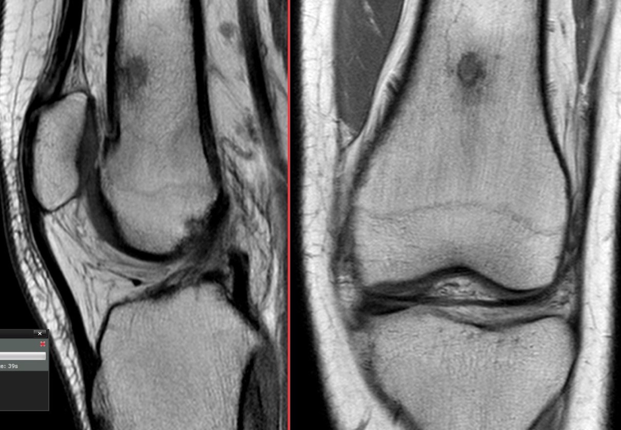 Figure 3 for case osteoid osteoma ( RID4005 )
